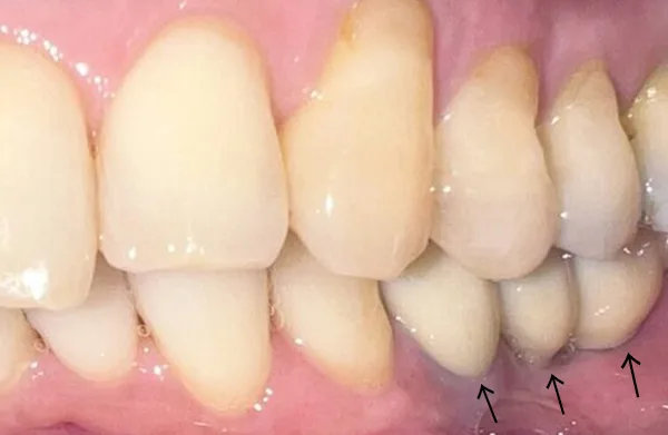 日本歯科グループの症例写真・治療後