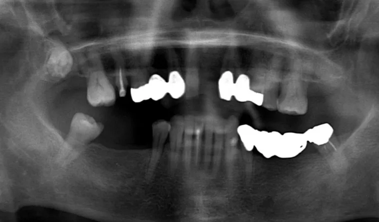 日本歯科グループの症例写真・治療前