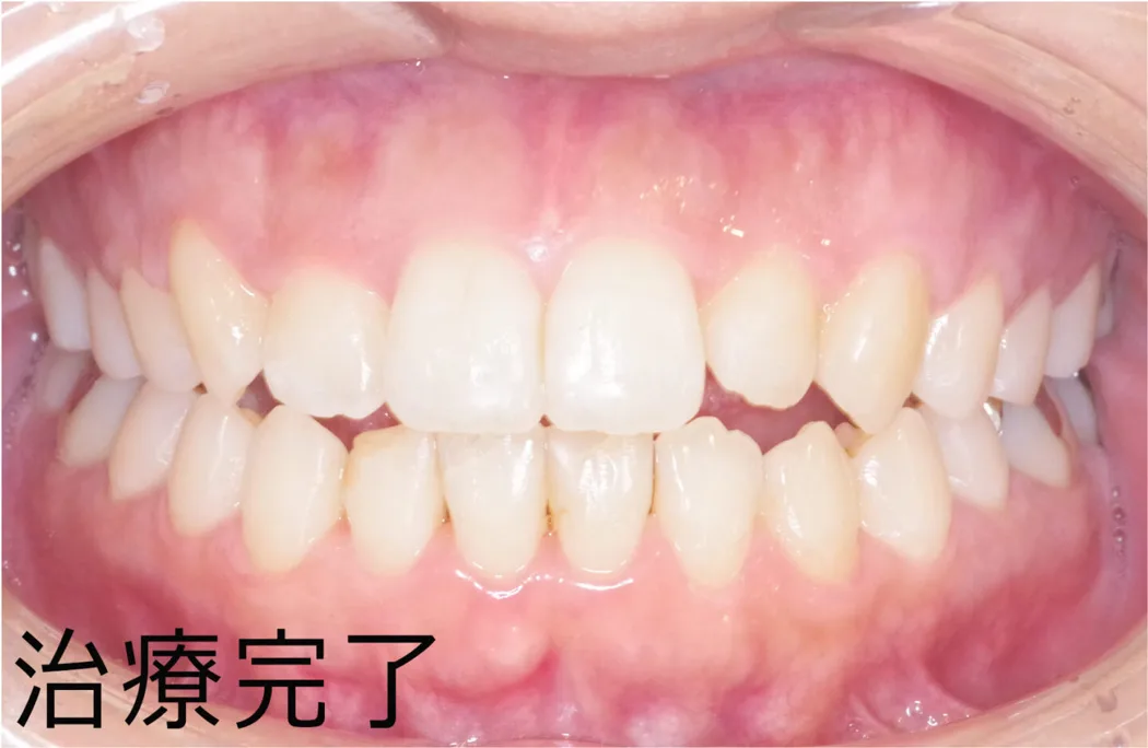 日本歯科グループの症例写真・治療後